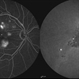Multifocal CSCR Multifocal CSCR
